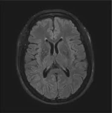 दिमाग़ का MRI स्कैन